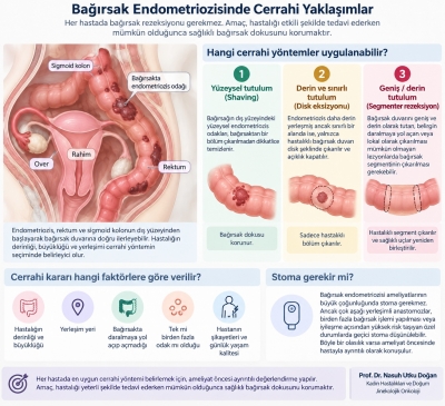 Bağırsak endometriozisinde her zaman bağırsak rezeksiyonu gerekir mi?