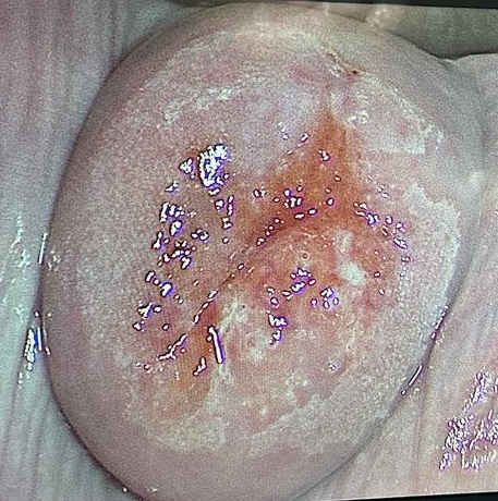 HPV (Human papilloma virüs), genital siğil, rahim ağzı kanseri öncüsü lezyonlarda tanı tedavi