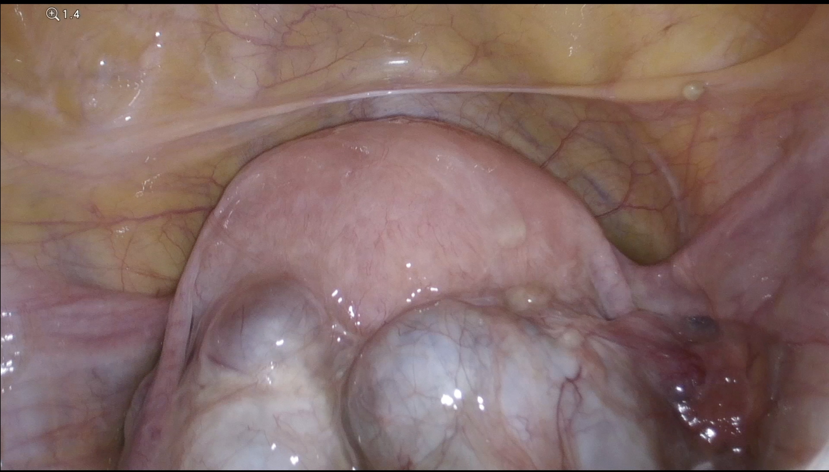 Kronik Pelvik Ağrı, Çikolata kisti hastalığı, derin infiltran endometriozis